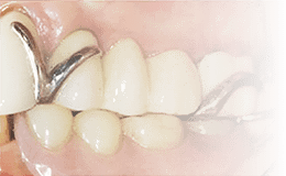 鉤歯となる歯は、入れ歯を支えるバネがかかっているため、これも過度な負担がかりやすくなります。